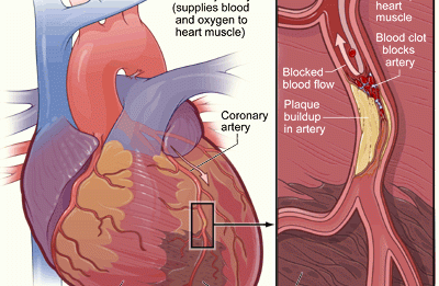 Високия холестерол причинява инфаркт