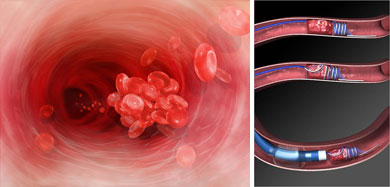 Образуването на тромб в кръвта е съпроводено то различни симптоми